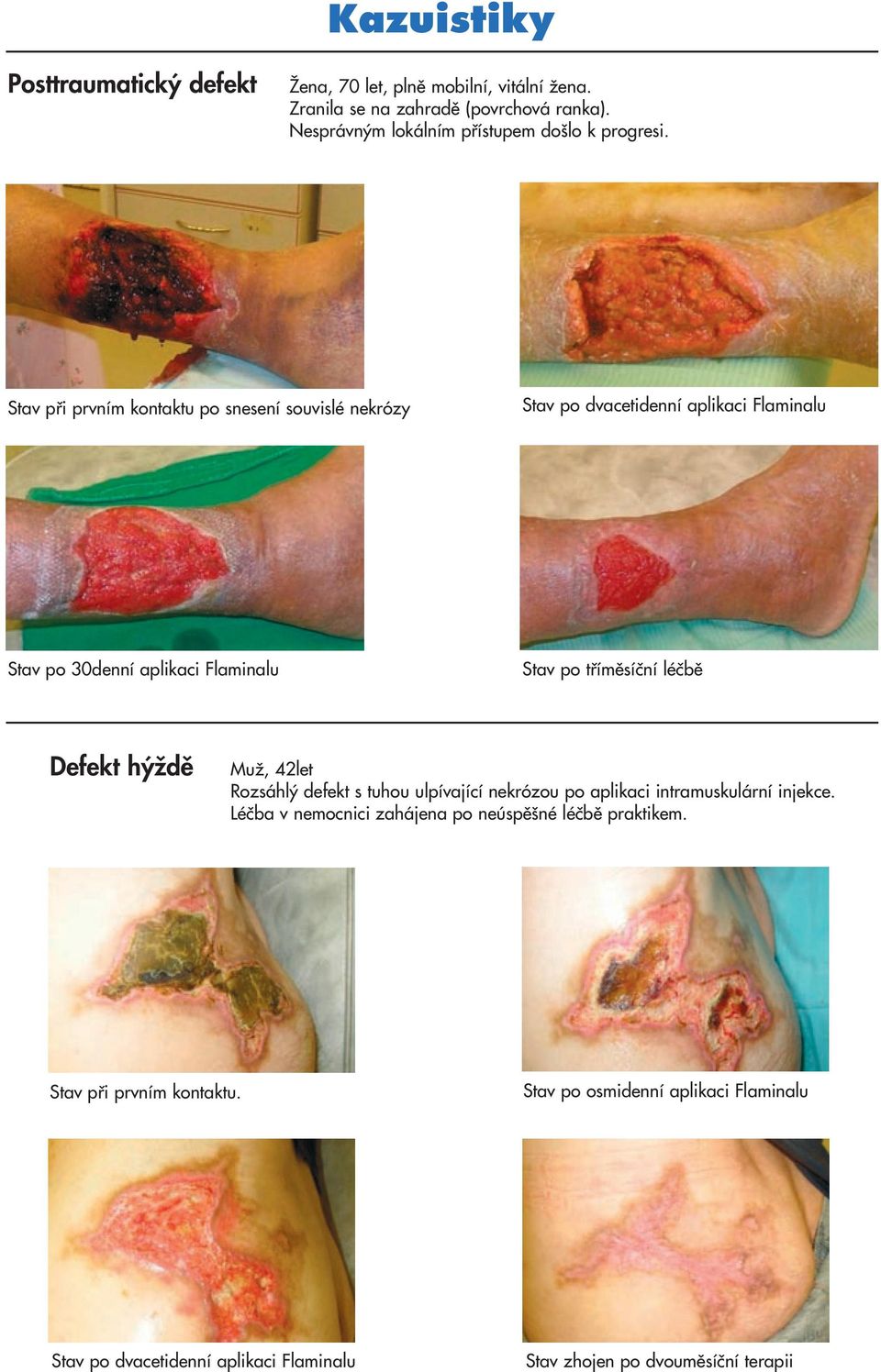 Stav pfii prvním kontaktu po snesení souvislé nekrózy Stav po dvacetidenní aplikaci Flaminalu Stav po 30denní aplikaci Flaminalu Stav po tfiímûsíãní léãbû