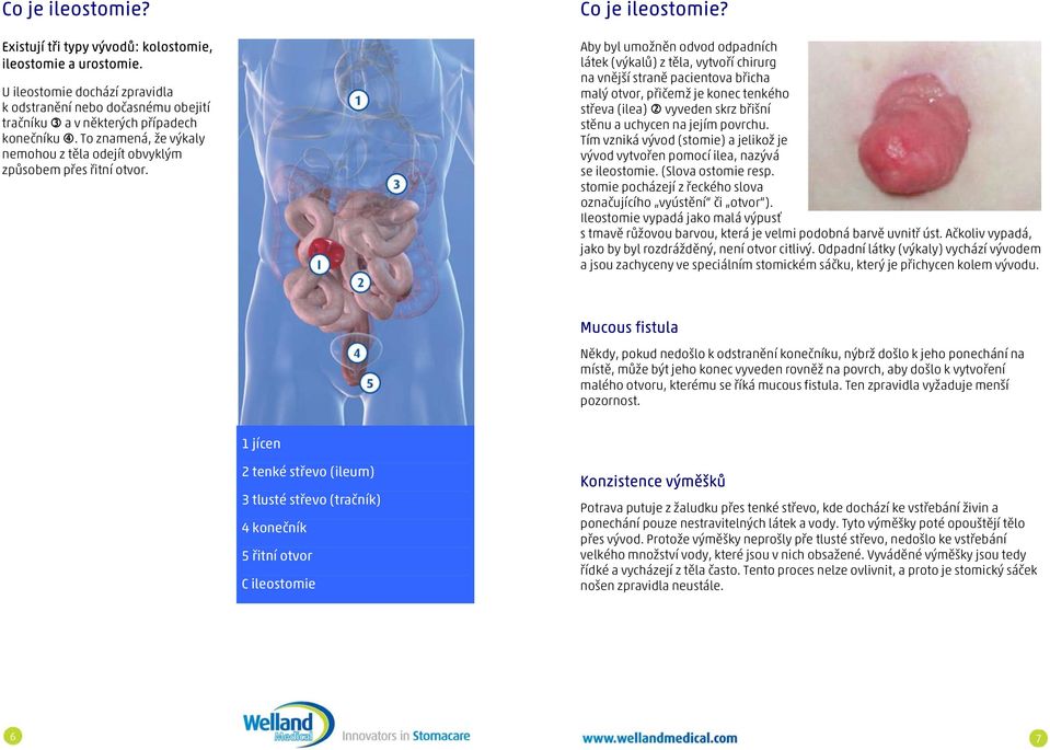 Aby byl umožněn odvod odpadních látek (výkalů) z těla, vytvoří chirurg na vnější straně pacientova břicha malý otvor, přičemž je konec tenkého střeva (ilea) vyveden skrz břišní stěnu a uchycen na