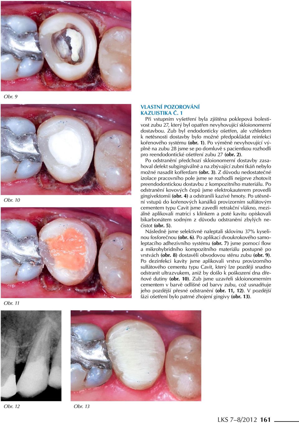 Po výměně nevyhovující výplně na zubu 28 jsme se po domluvě s pacientkou rozhodli pro reendodontické ošetření zubu 27 (obr. 2).