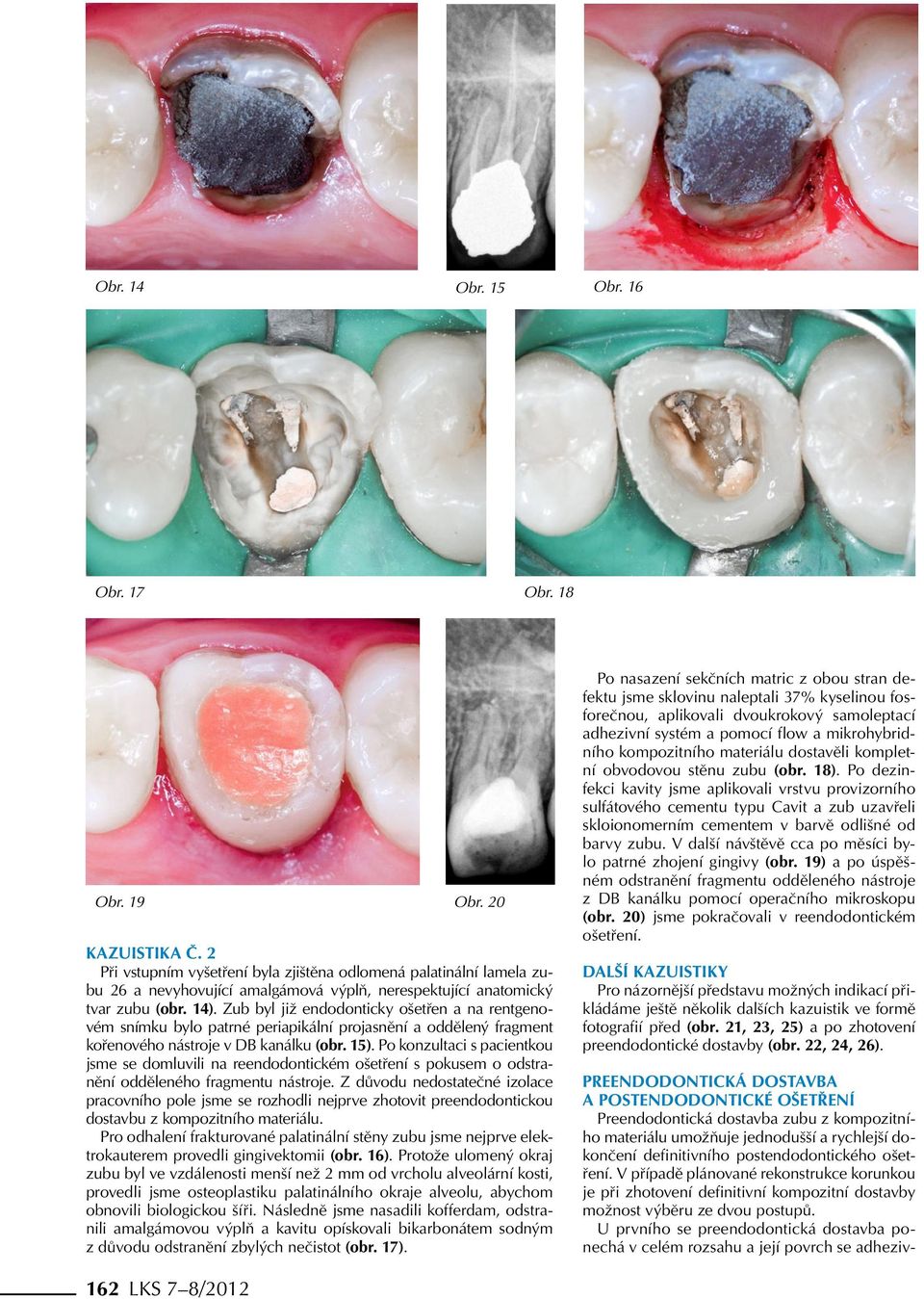Zub byl již endodonticky ošetřen a na rentgenovém snímku bylo patrné periapikální projasnění a oddělený fragment kořenového nástroje v DB kanálku (obr. 15).