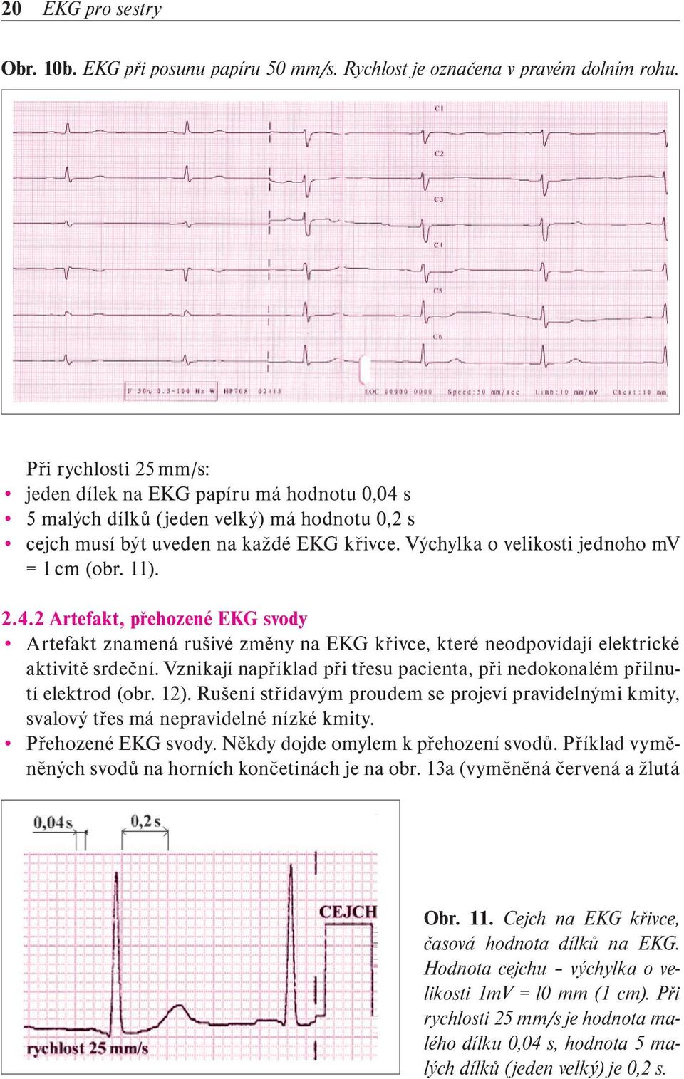 11). 2.4.2 Artefakt, přehozené EKG svody Artefakt znamená rušivé změny na EKG křivce, které neodpovídají elektrické aktivitě srdeční.