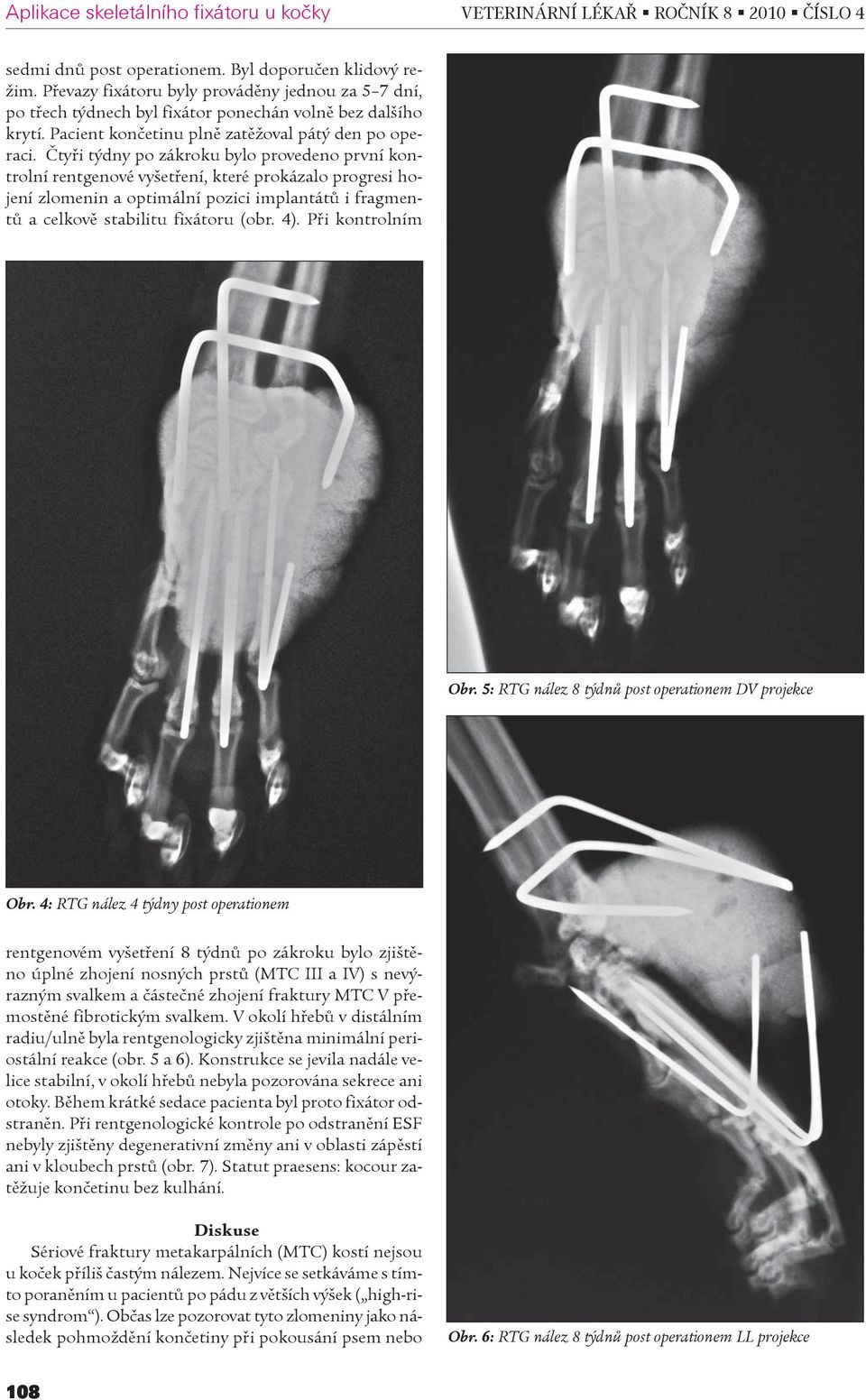 Ètyøi týdny po zákroku bylo provedeno první kontrolní rentgenové vyšetøení, které prokázalo progresi hojení zlomenin a optimální pozici implantátù i fragmentù a celkovì stabilitu fixátoru (obr. 4).