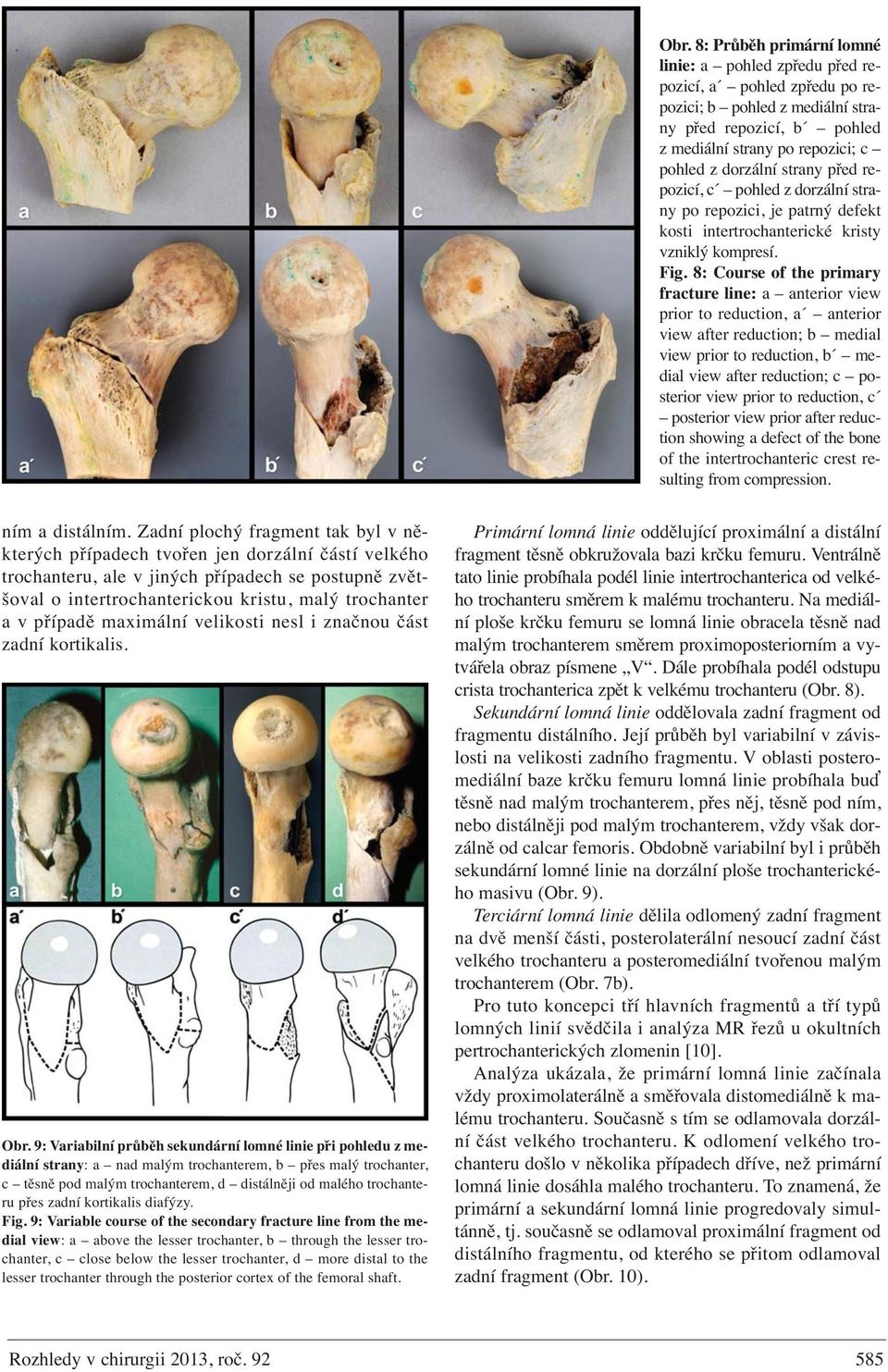 8: Course of the primary fracture line: a anterior view prior to reduction, a anterior view after reduction; b medial view prior to reduction, b medial view after reduction; c posterior view prior to