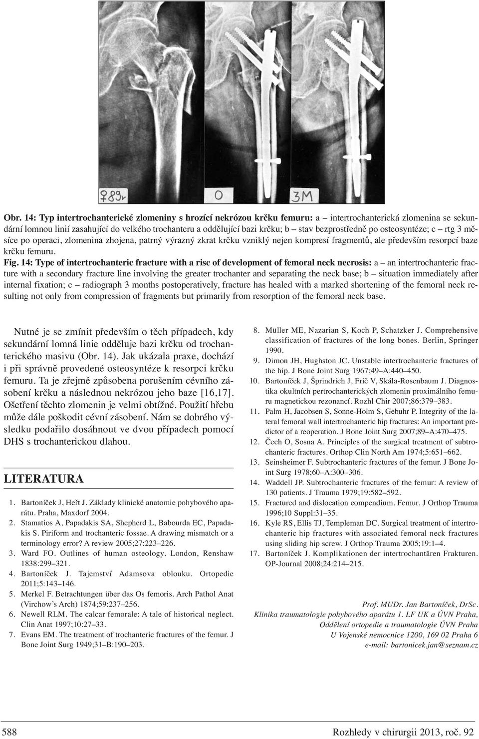 14: Type of intertrochanteric fracture with a risc of development of femoral neck necrosis: a an intertrochanteric fracture with a secondary fracture line involving the greater trochanter and