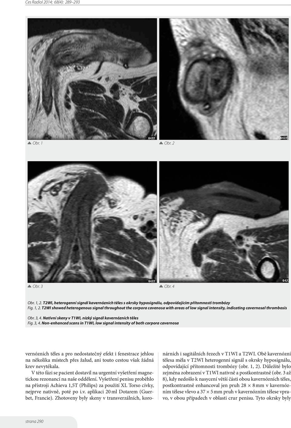 Non-enhanced scans in T1WI, low signal intensity of both corpora cavernosa vernózních těles a pro nedostatečný efekt i fenestrace jehlou na několika místech přes žalud, ani touto cestou však žádná