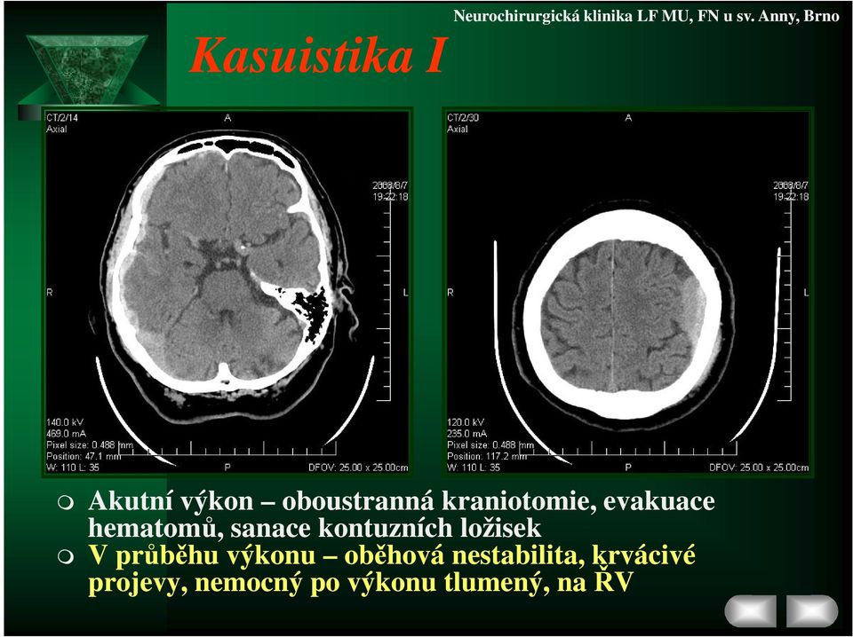 kontuzních ložisek V průběhu výkonu oběhová