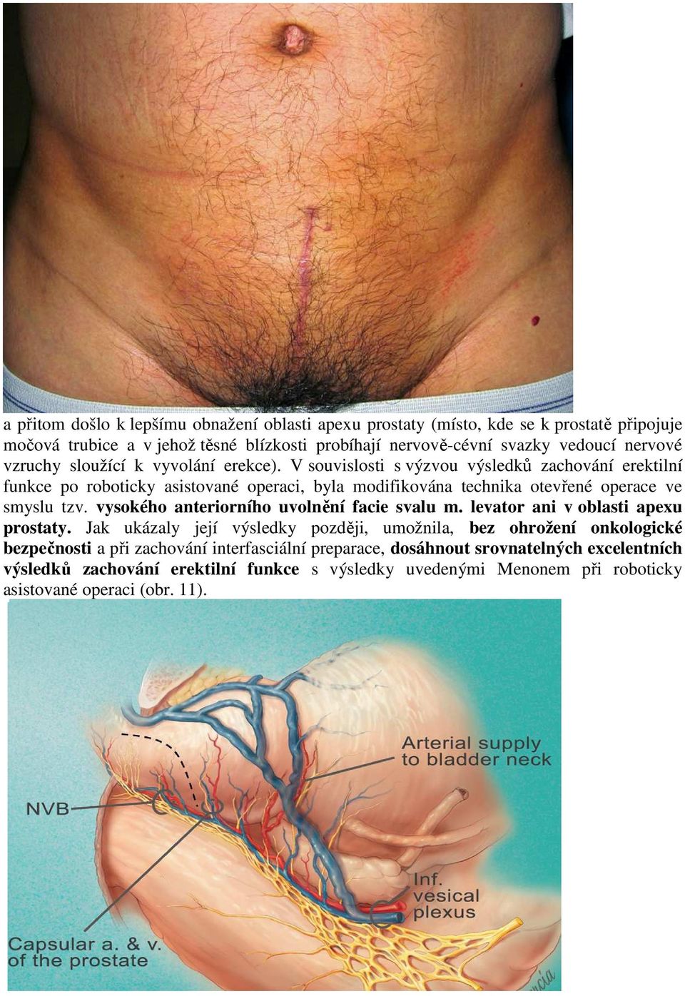 V souvislosti s výzvou výsledků zachování erektilní funkce po roboticky asistované operaci, byla modifikována technika otevřené operace ve smyslu tzv.