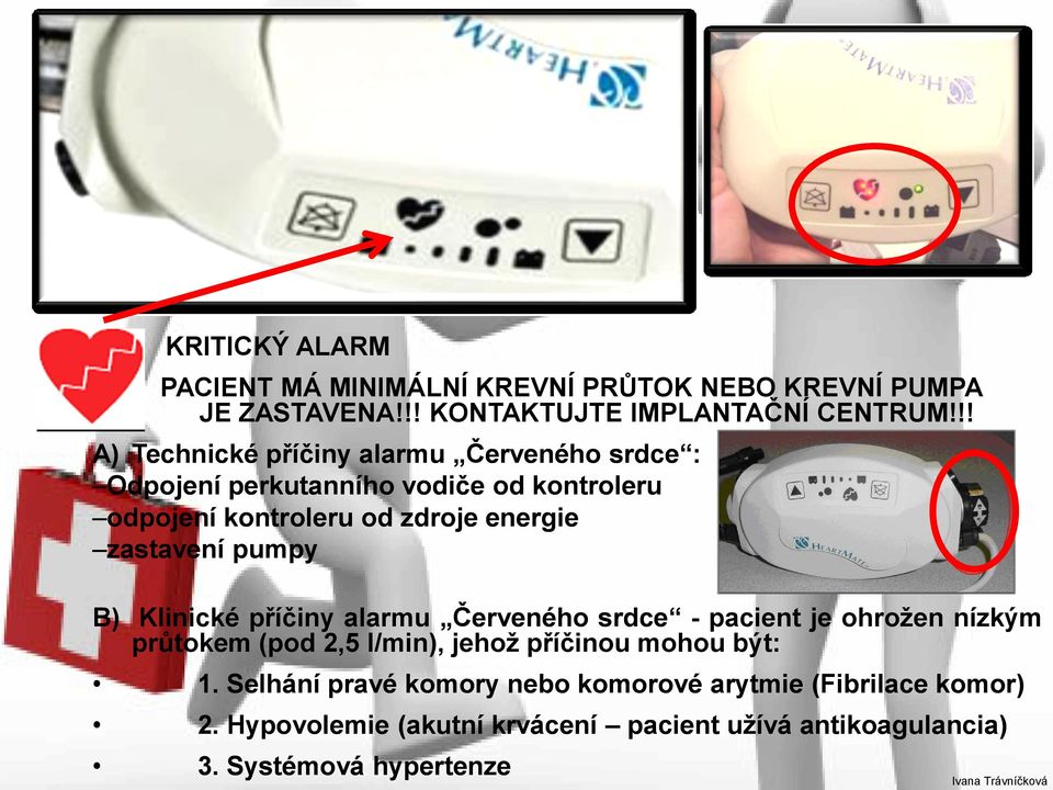 zastavení pumpy B) Klinické příčiny alarmu Červeného srdce - pacient je ohrožen nízkým průtokem (pod 2,5 l/min), jehož příčinou mohou