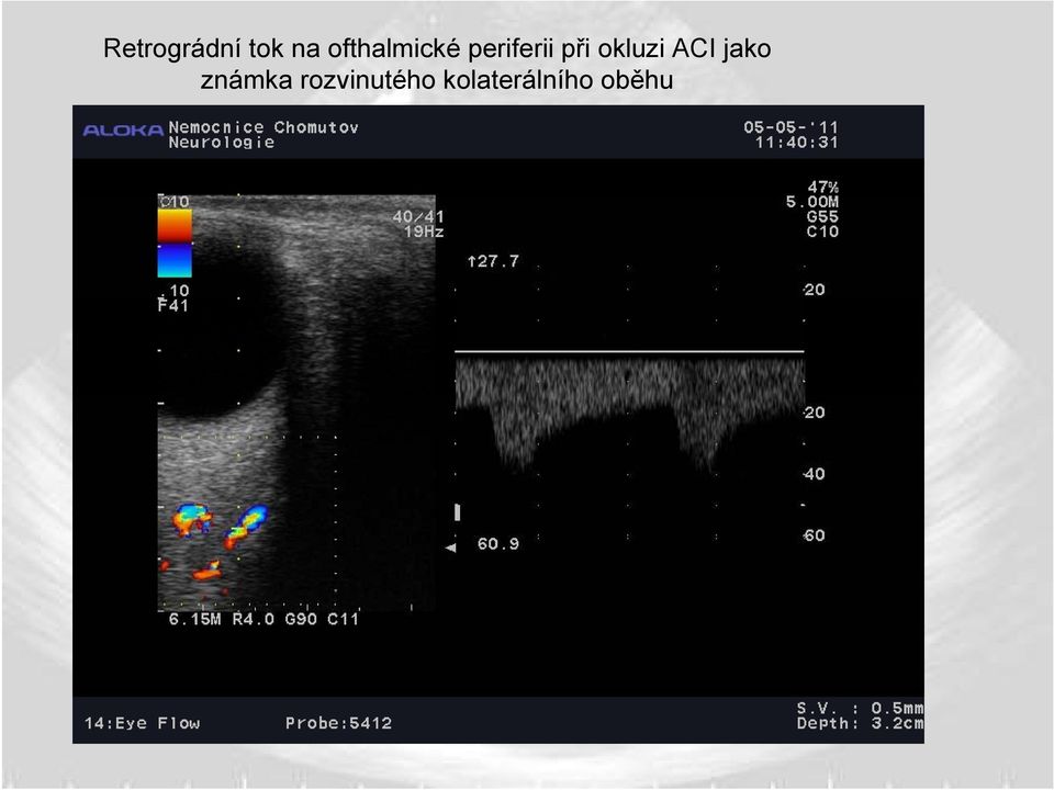 při okluzi ACI jako