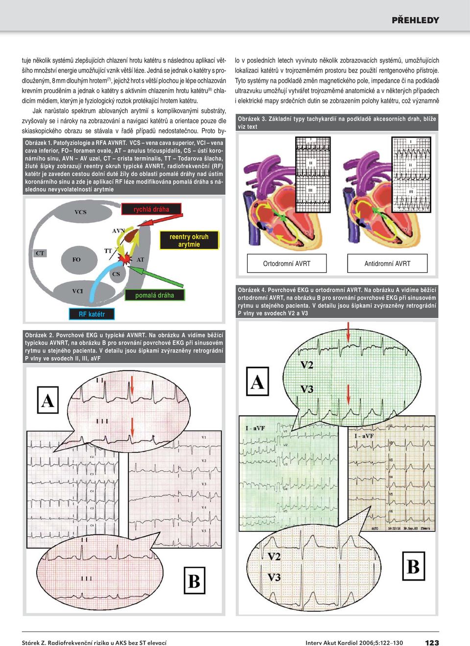 reentry okruh typické AVNRT, radiofrekvenční (RF) katétr je zaveden cestou dolní duté žíly do oblasti pomalé dráhy nad ústím koronárního sinu a zde je aplikací RF léze modifikována pomalá dráha s