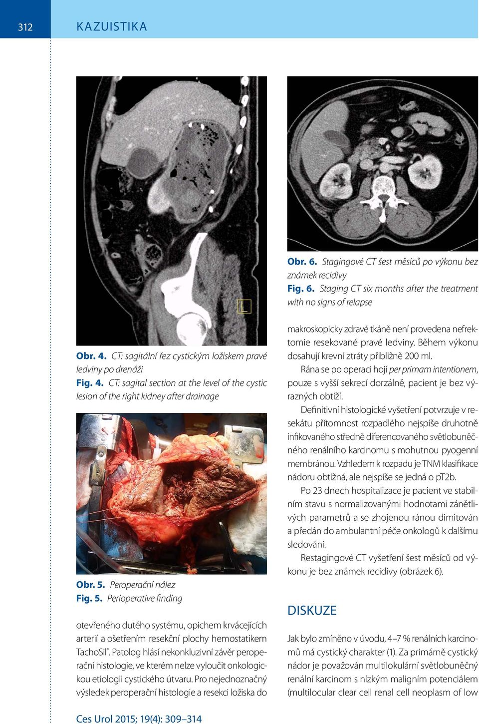 Peroperační nález Fig. 5. Perioperative finding otevřeného dutého systému, opichem krvácejících arterií a ošetřením resekční plochy hemostatikem TachoSil.