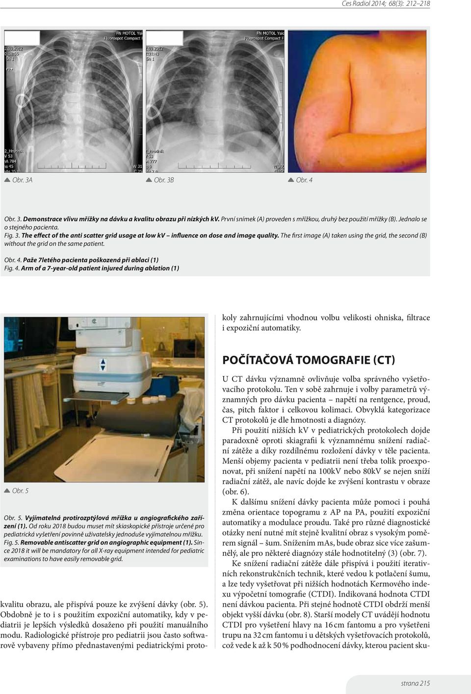 Paže 7letého pacienta poškozená při ablaci (1) Fig. 4. Arm of a 7-year-old patient injured during ablation (1) kvalitu obrazu, ale přispívá pouze ke zvýšení dávky (obr. 5).