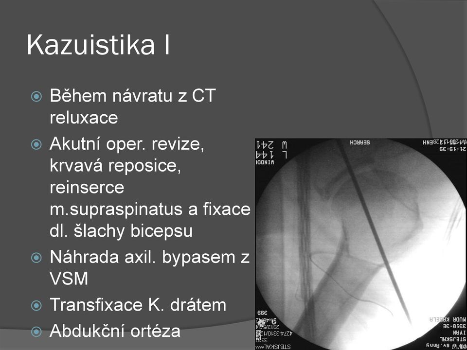 supraspinatus a fixace dl.