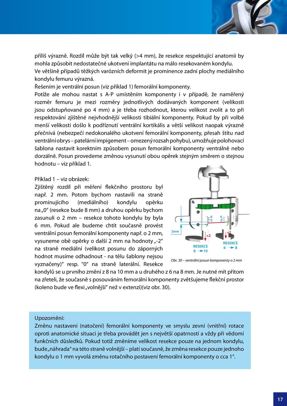 Potíže ale mohou nastat s A-P umístěním komponenty i v případě, že naměřený rozměr femuru je mezi rozměry jednotlivých dodávaných komponent (velikosti jsou odstupňované po 4 mm) a je třeba