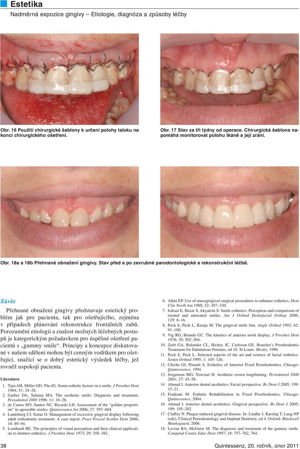 Závěr Přehnané obnažení gingivy představuje estetický problém jak pro pacienta, tak pro ošetřujícího, zejména v případech plánování rekonstrukce frontálních zubů.