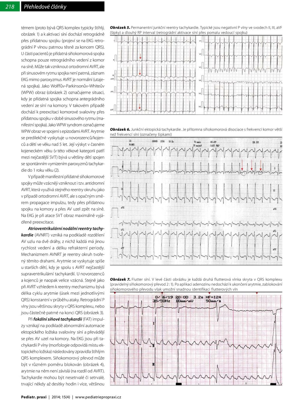 Může tak vzniknout ortodromní AVRT, ale při sinusovém rytmu spojka není patrná, záznam EKG mimo paroxyzmus AVRT je normální (utajená spojka).