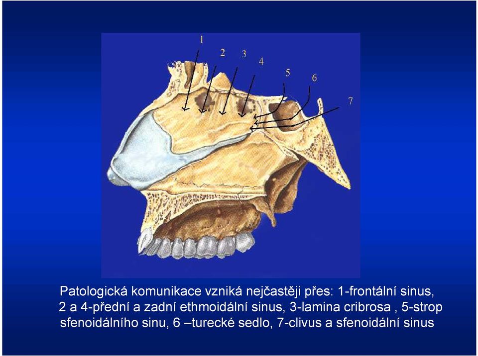 ethmoidální sinus, 3-lamina cribrosa, 5-strop