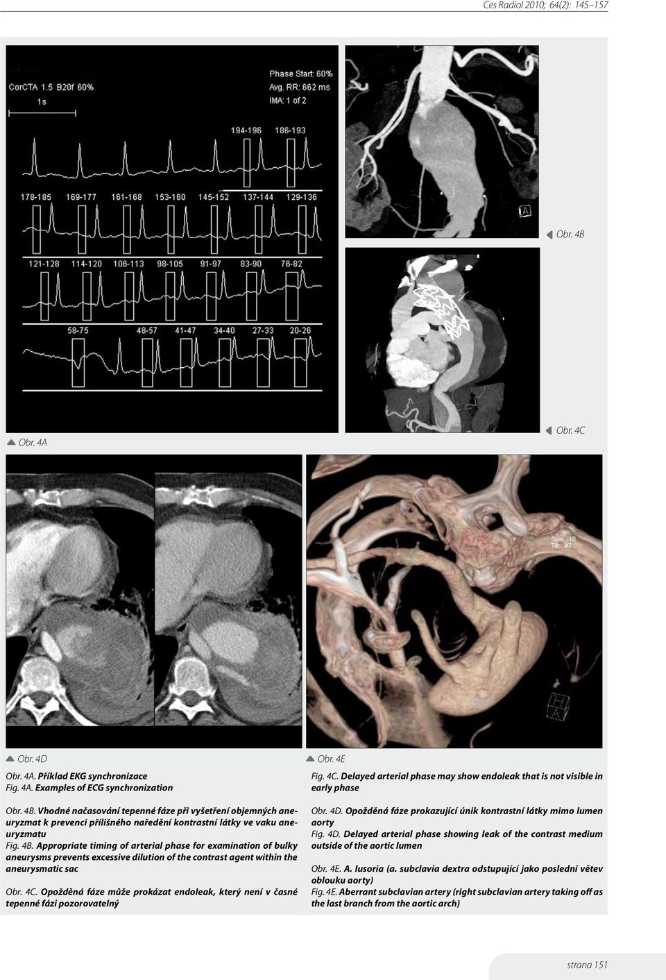 Appropriate timing of arterial phase for examination of bulky aneurysms prevents excessive dilution of the contrast agent within the aneurysmatic sac Obr. 4C.