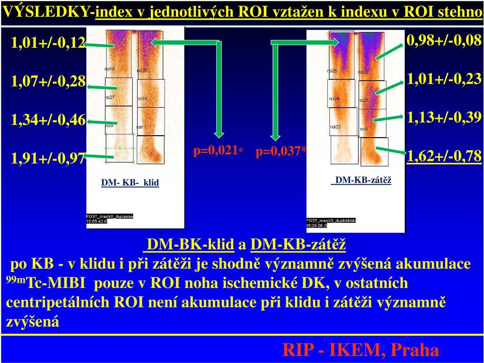 DM-KB-zátěž DM-BK-klid a DM-KB-zátěž po KB - v klidu i při zátěži je shodně významně zvýšená akumulace 99m