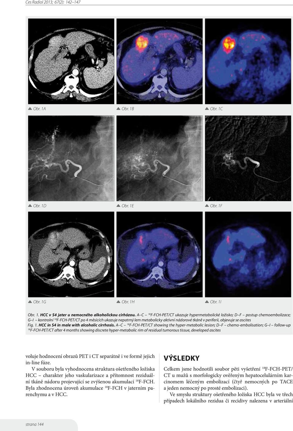 se ascites Fig. 1. HCC in S4 in male with alcoholic cirrhosis.