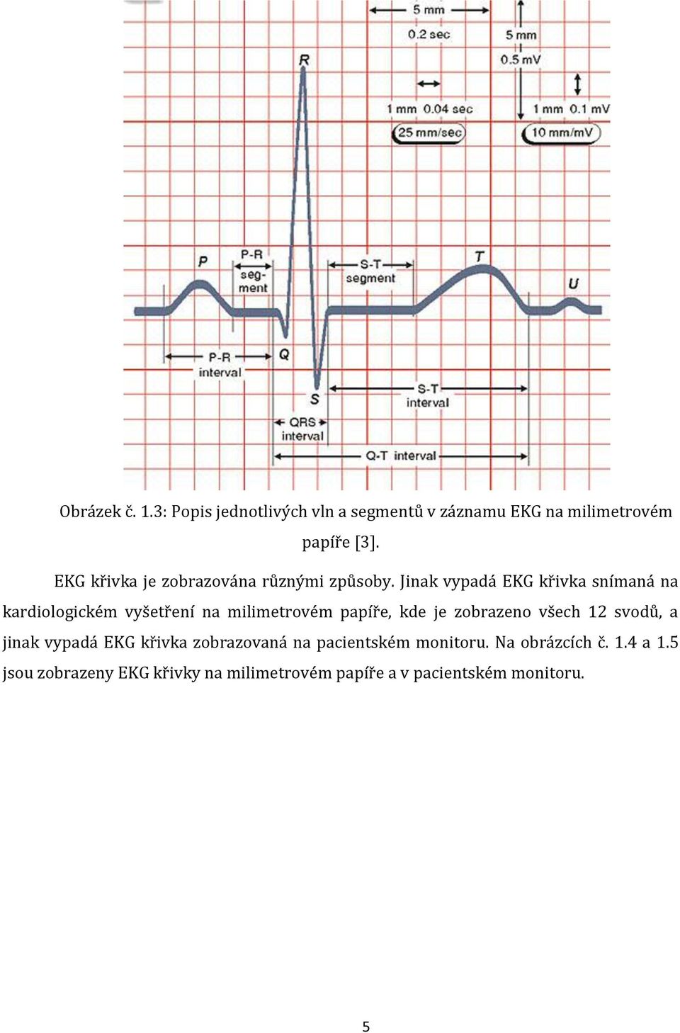 Jinak vypadá EKG křivka snímaná na kardiologickém vyšetření na milimetrovém papíře, kde je zobrazeno