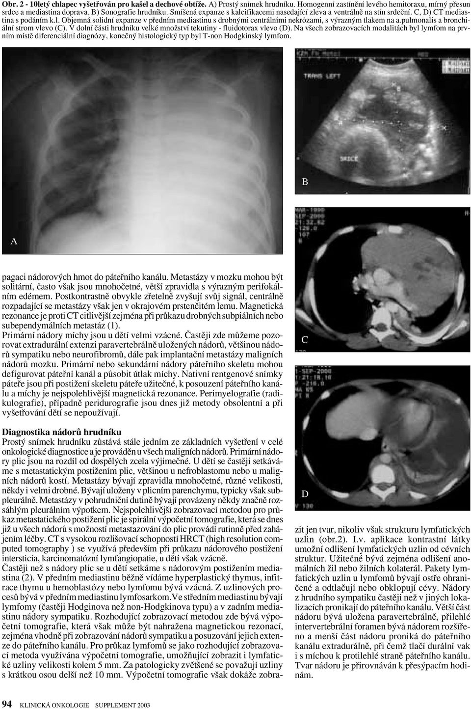 pulmonalis a bronchiální strom vlevo (C). V dolní ãásti hrudníku velké mnoïství tekutiny - fluidotorax vlevo (D).