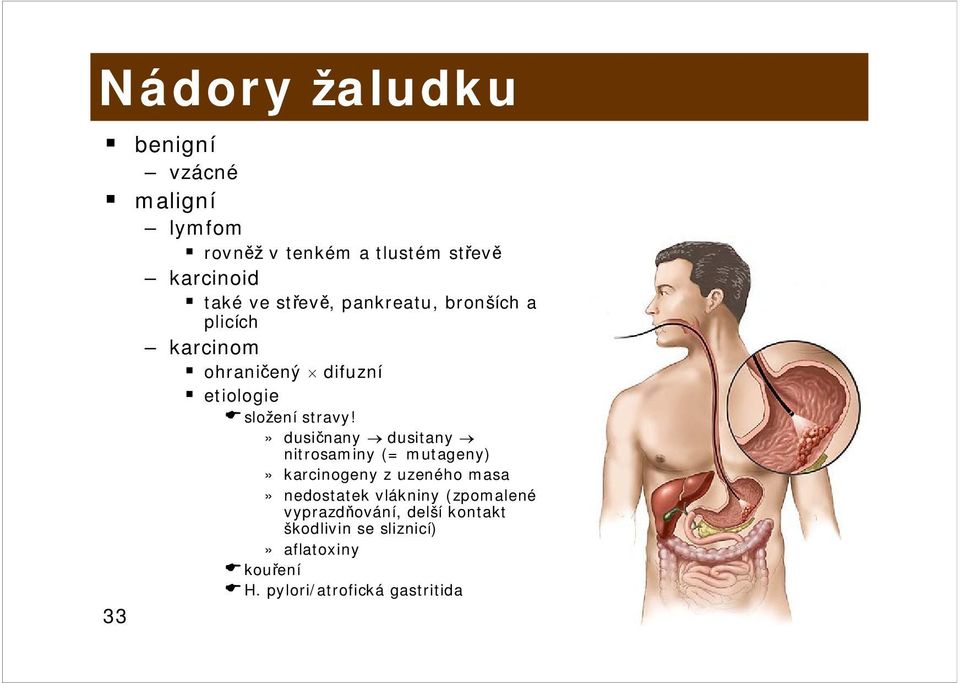 » dusičnany dusitany nitrosaminy (= mutageny)» karcinogeny z uzeného masa» nedostatek vlákniny