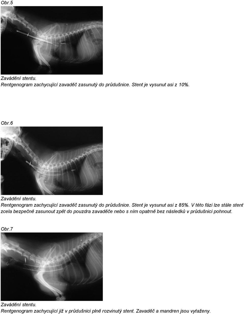 V této fázi lze stále stent zcela bezpečně zasunout zpět do pouzdra zavaděče nebo s ním opatrně bez následků v