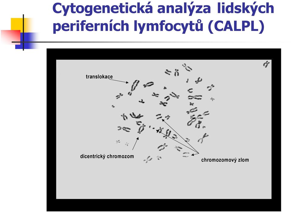 lymfocytů (CALPL)