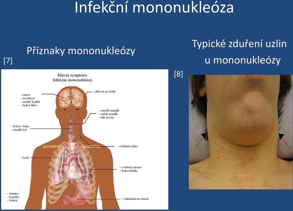 mononukleózy [8]