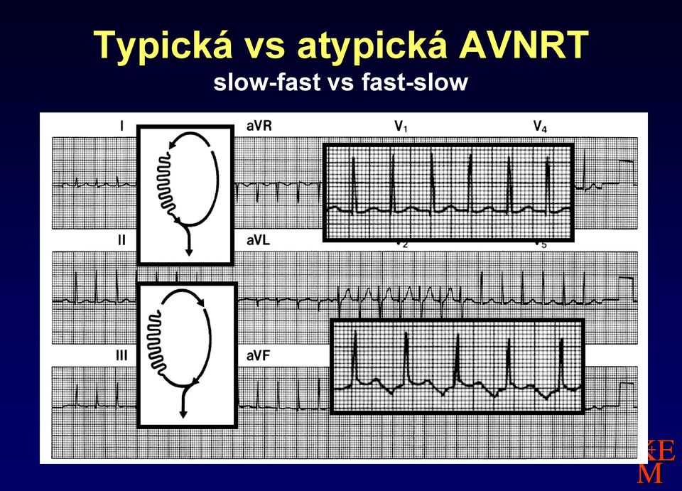 AVNRT