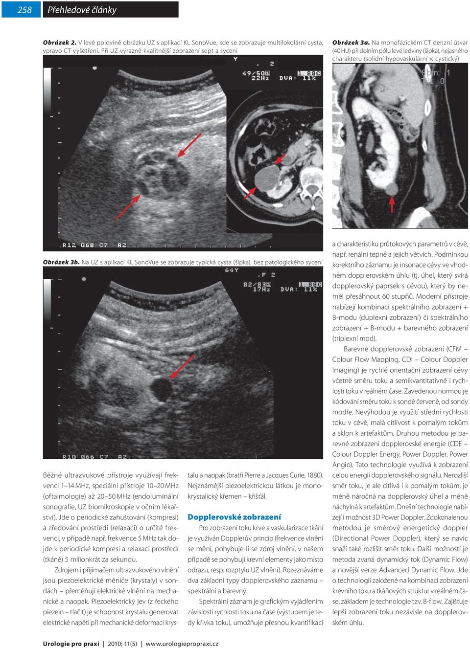 Na monofázickém CT denzní útvar (40 HU) při dolním pólu levé ledviny (šipka), nejasného charakteru (solidní hypovaskulární cystický) Obrázek 3b.