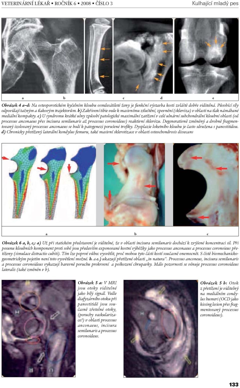 c) U syndromu krátké ulny zpùsobí patologické maximální zatížení v celé ulnární subchondrální kloubní oblasti (od processus anconaeus pøes incisura semilunaris až processus coronoideus) reaktivní