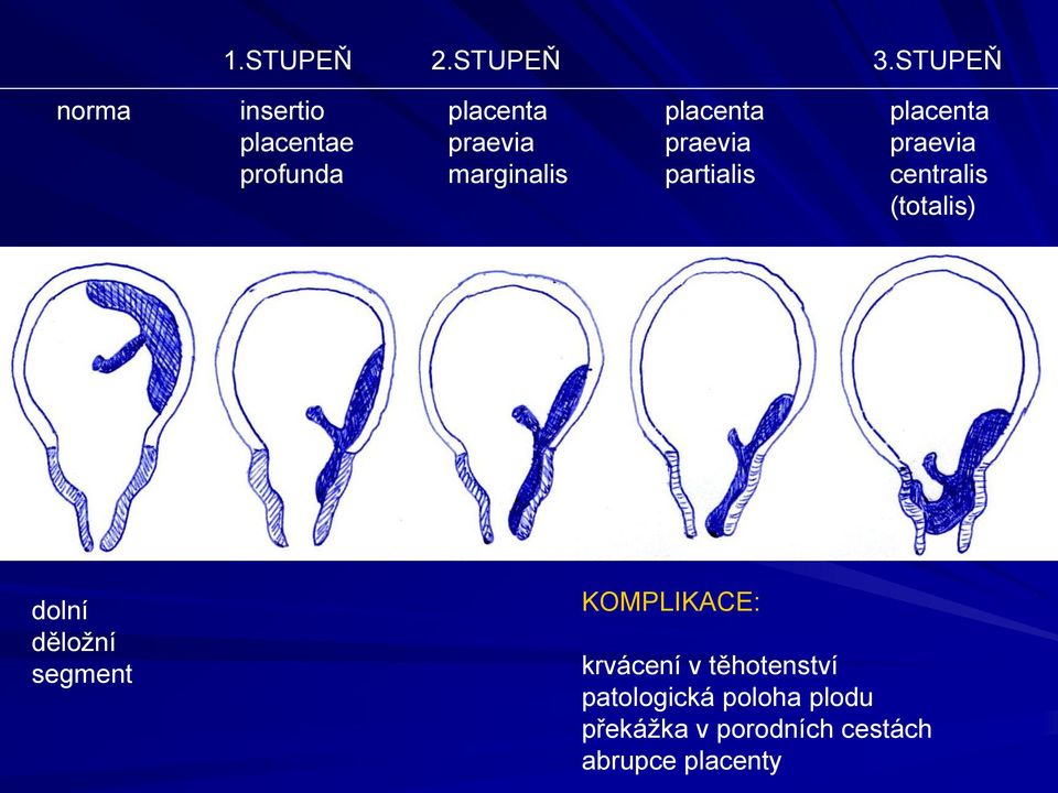 placenta praevia partialis placenta praevia centralis (totalis) dolní