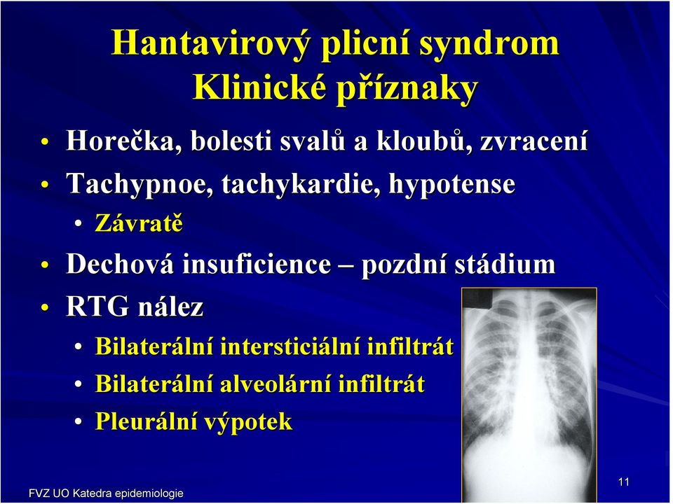 insuficience pozdní stádium RTG nálezn Bilateráln lní intersticiáln