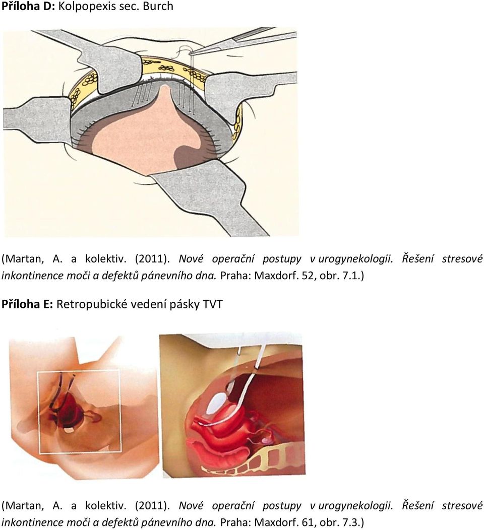 Praha: Maxdorf. 52, obr. 7.1.) Příloha E: Retropubické vedení pásky TVT (Martan, A. a kolektiv.