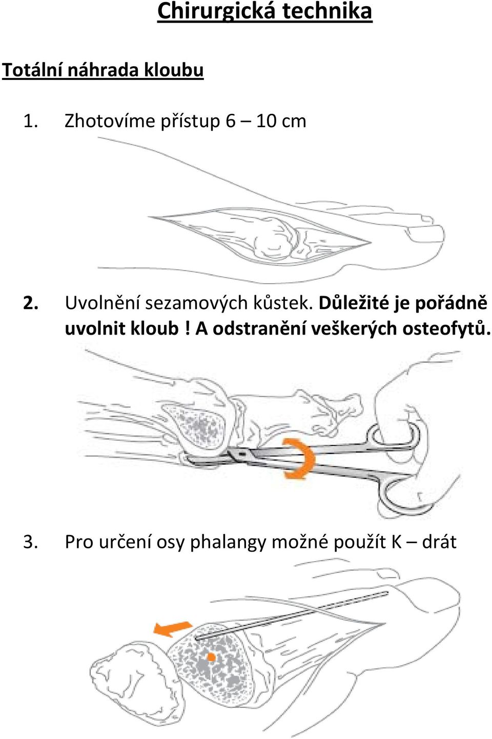 Uvolnění sezamových kůstek.