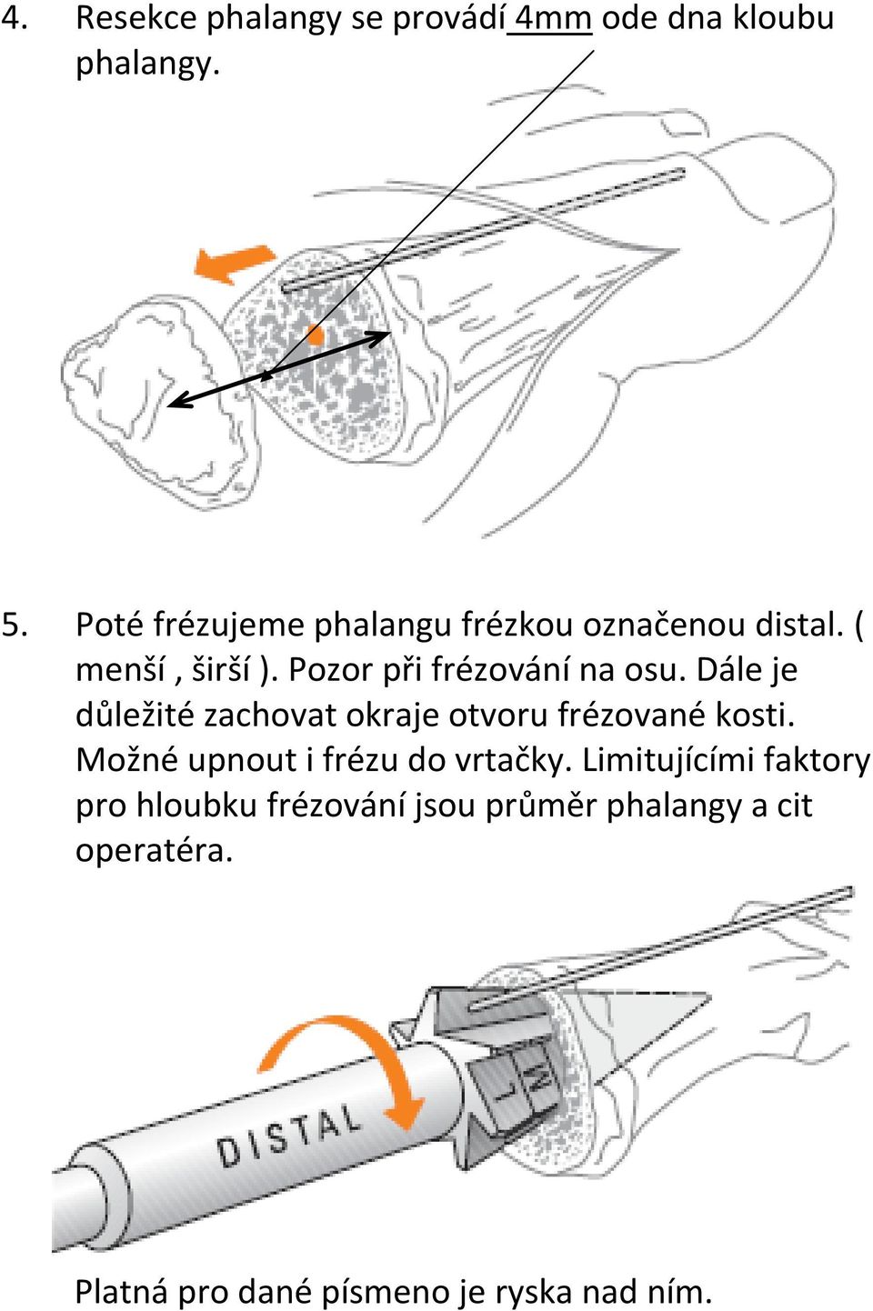 Pozor při frézování na osu. Dále je důležité zachovat okraje otvoru frézované kosti.