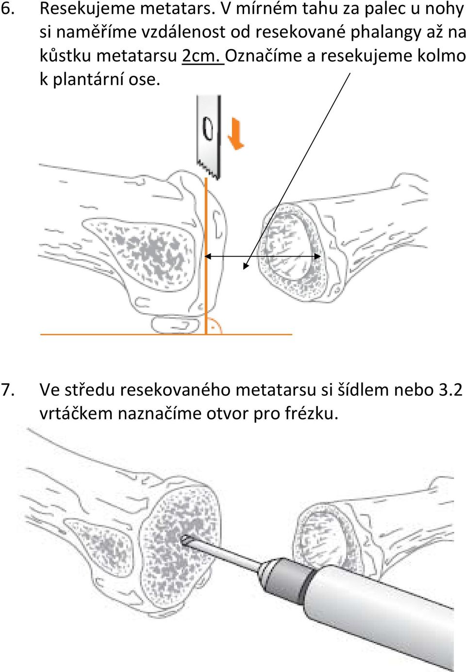 resekované phalangy až na kůstku metatarsu 2cm.