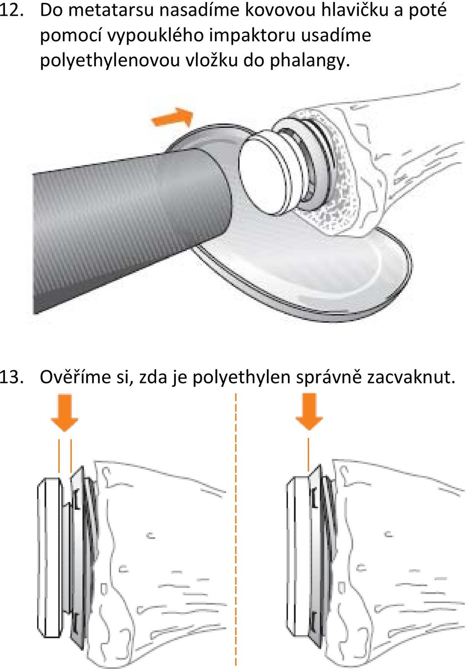 polyethylenovou vložku do phalangy. 13.