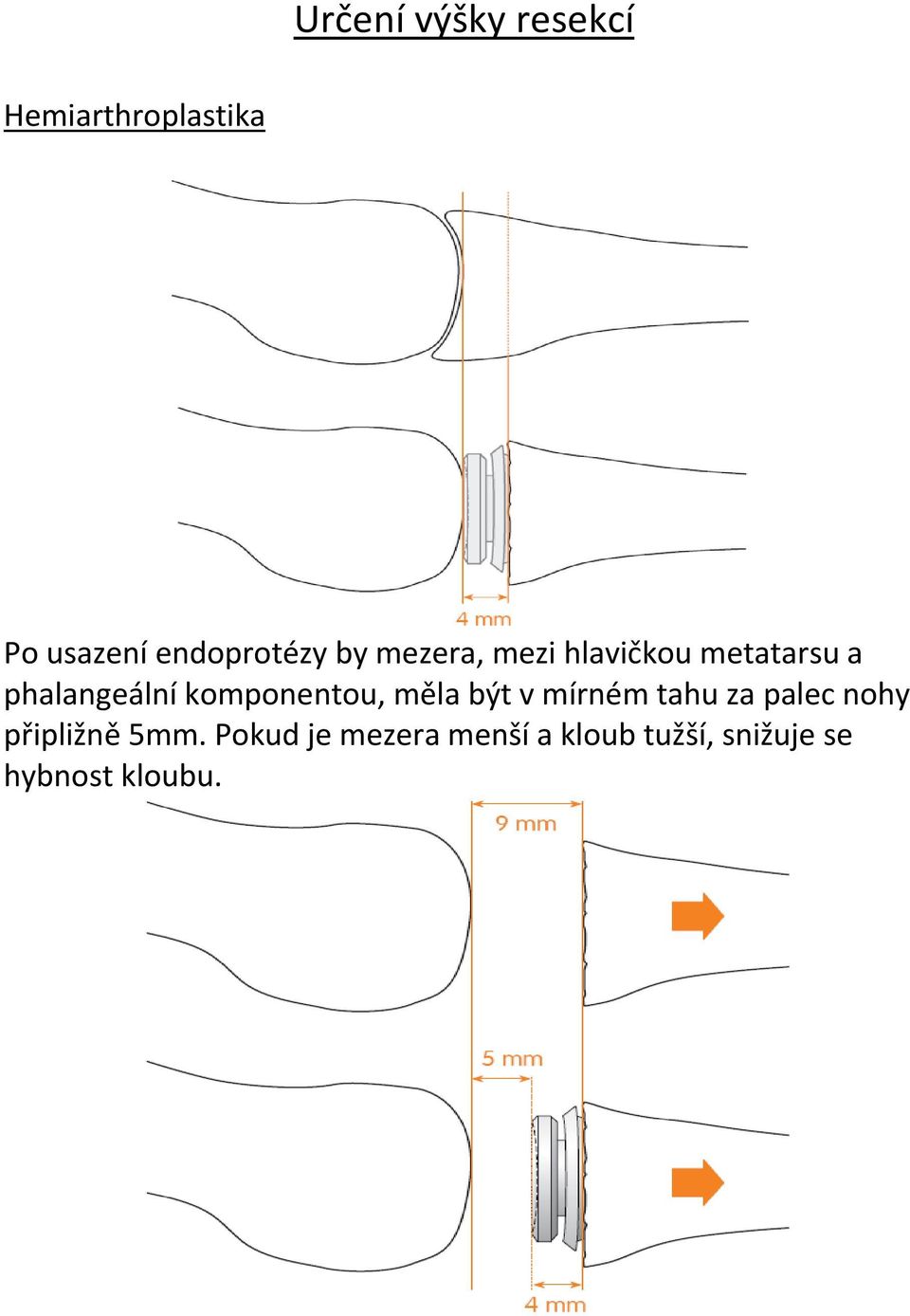 phalangeální komponentou, měla být v mírném tahu za palec