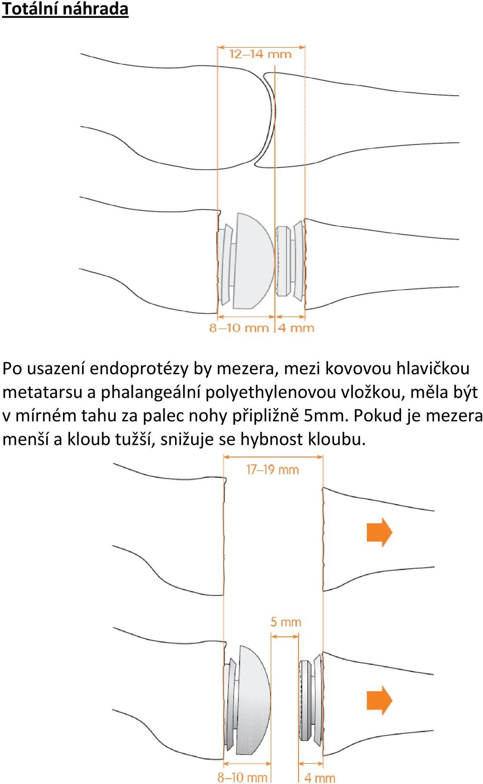 vložkou, měla být v mírném tahu za palec nohy připližně 5mm.