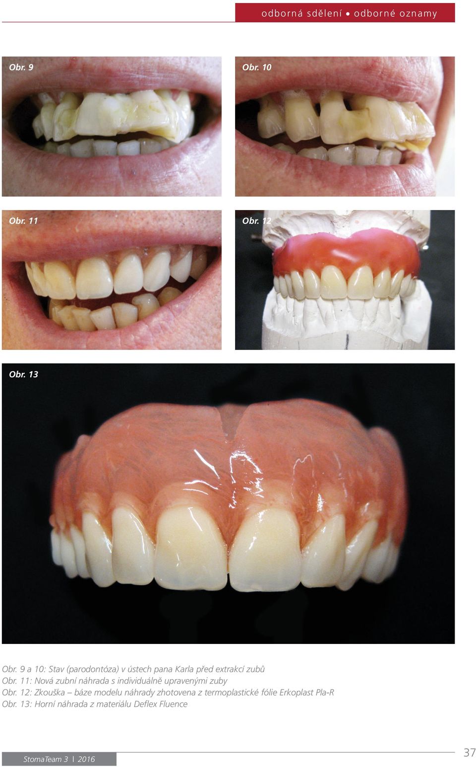 11: Nová zubní náhrada s individuálně upravenými zuby Obr.