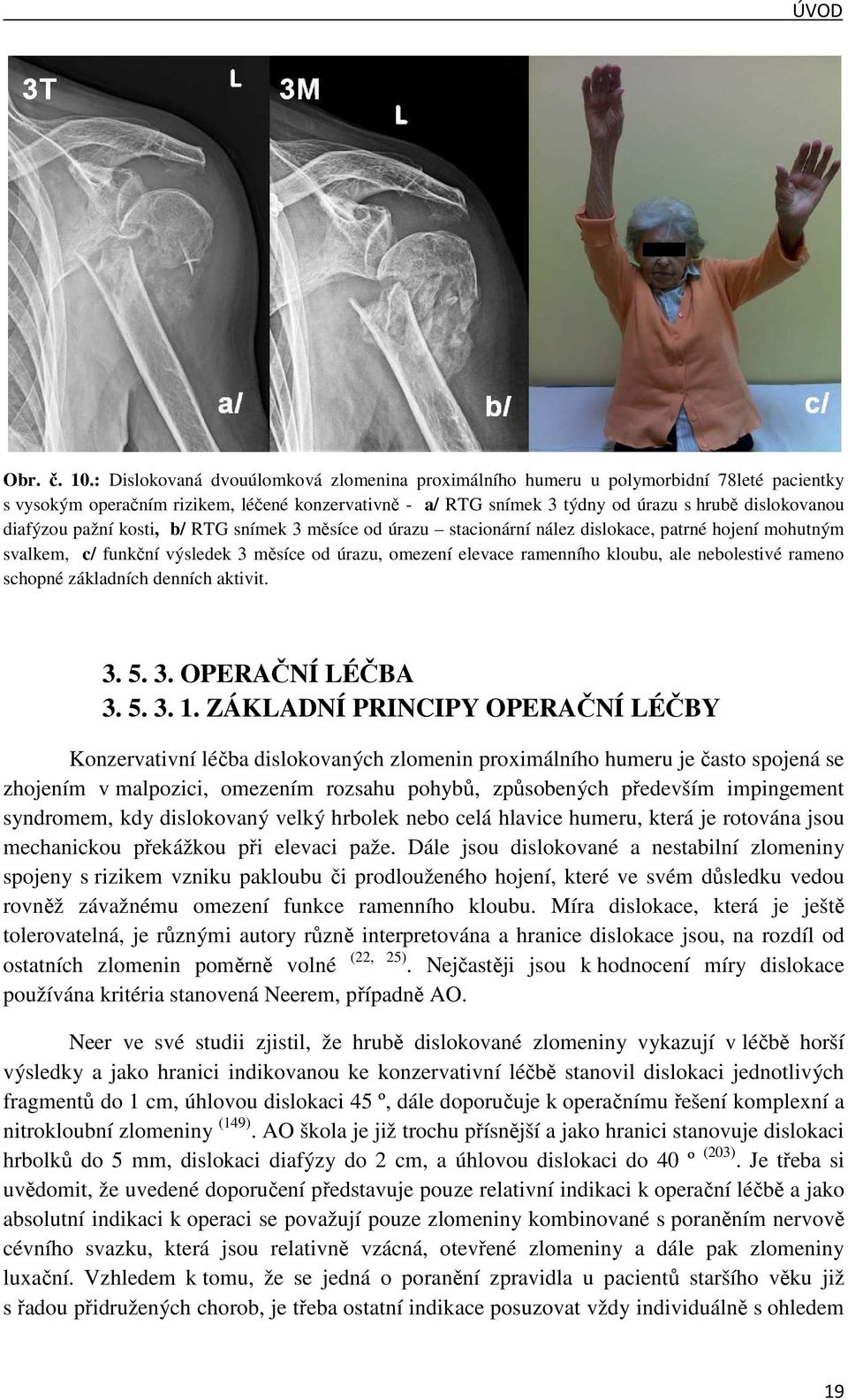 diafýzou pažní kosti, b/ RTG snímek 3 měsíce od úrazu stacionární nález dislokace, patrné hojení mohutným svalkem, c/ funkční výsledek 3 měsíce od úrazu, omezení elevace ramenního kloubu, ale