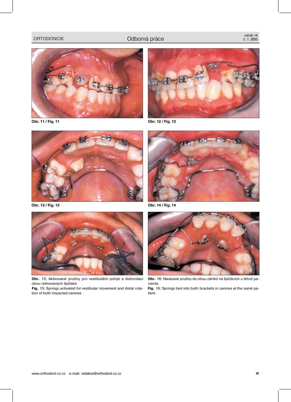 16: Springs tied into both brackets in canines at the samé pa- tient Obr.