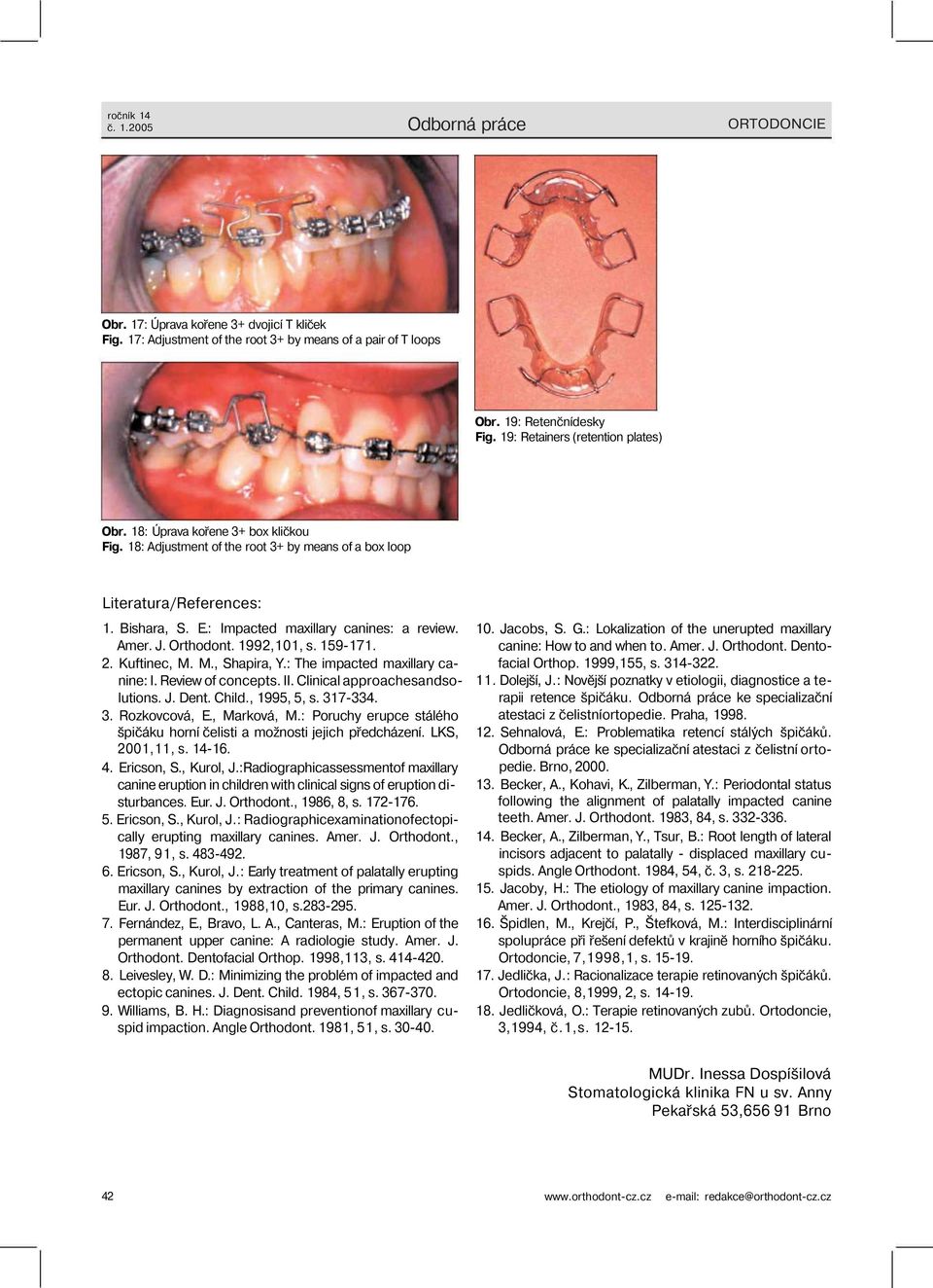 1992,101, s. 159-171. 2. Kuftinec, M. M., Shapira, Y.: The impacted maxillary canine: I. Review of concepts. II. Clinical approachesandsolutions. J. Dent. Child., 1995, 5, s. 317-334. 3. Rozkovcová, E.