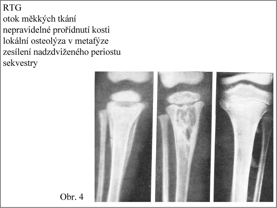 lokální osteolýza v metafýze