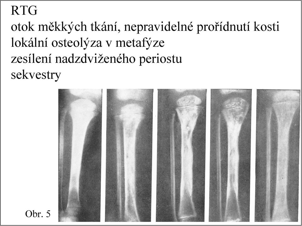 lokální osteolýza v metafýze