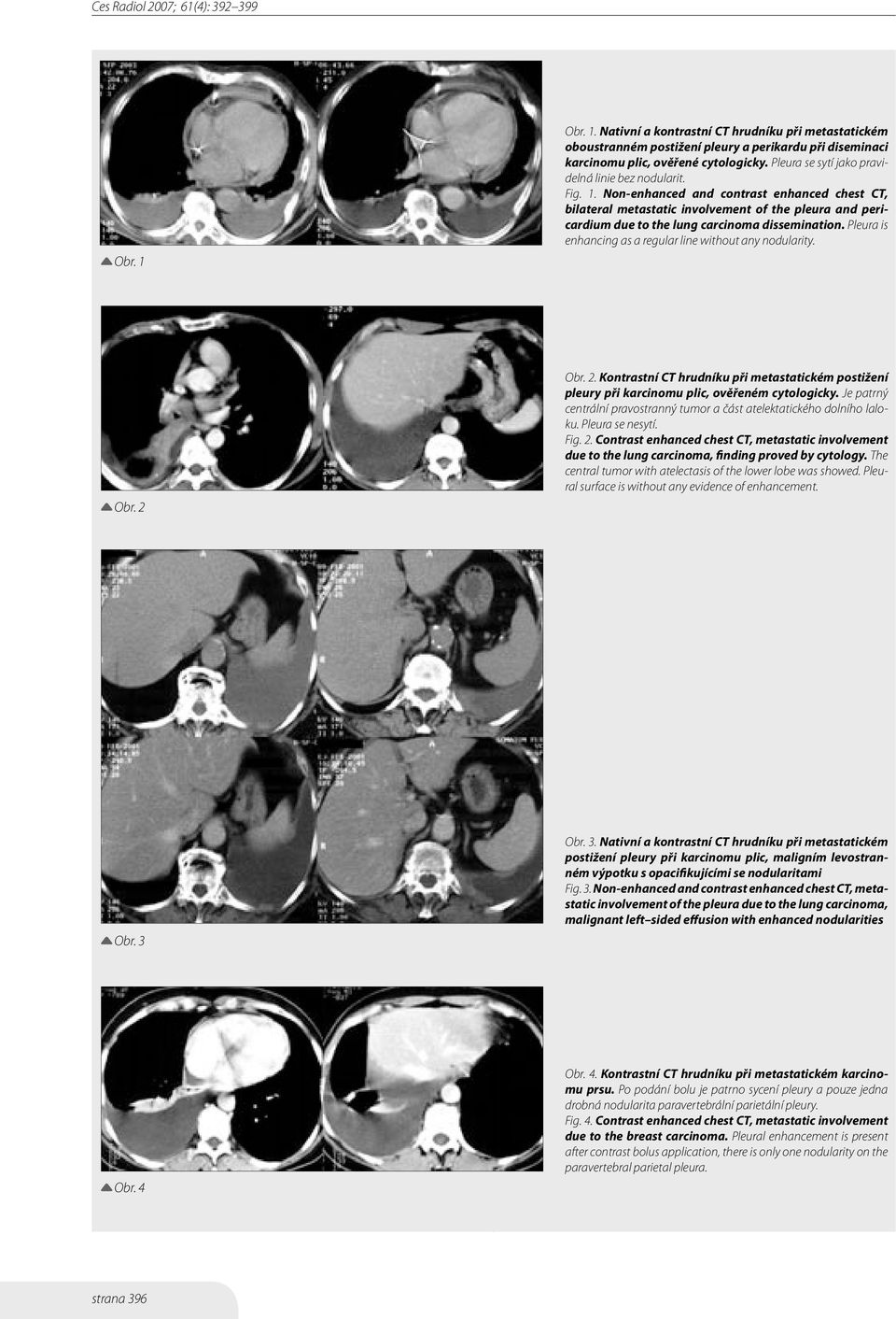 Non-enhanced and contrast enhanced chest CT, bilateral metastatic involvement of the pleura and pericardium due to the lung carcinoma dissemination.