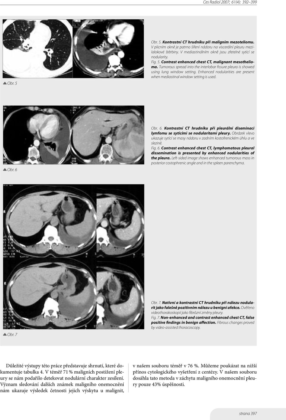 Tumorous spread into the interlobar fissure pleura is showed using lung window setting. Enhanced nodularities are present when mediastinal window setting is used. Obr. 6 